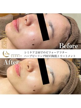 エスプリ 銀座店/ハーブピーリング銀座