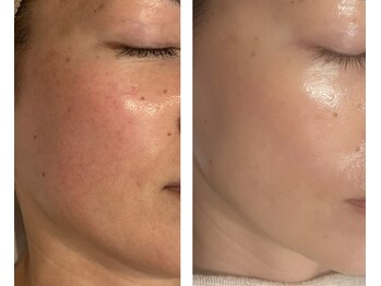 アドビューティ(Add Beauty)/≪プラズマフェイシャル≫