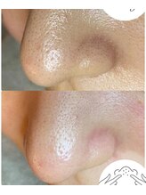 エヌ ドット ジュウイチ(N.11)/黒ずみ毛穴洗浄