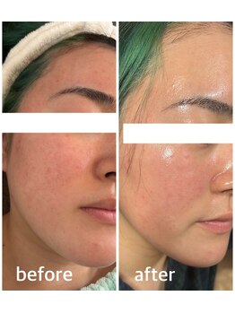 エムシー(MC)/赤み肌