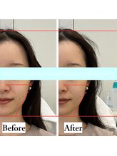 キレミラ 麻布十番店/リフトアップBefore/After(2)