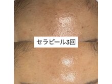 ヴィヴ 三島店(Vive)/《セラピール》症例