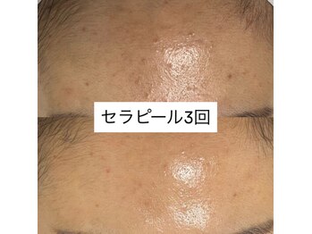 ヴィヴ 三島店(Vive)/《セラピール》症例