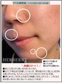 ハーバリー ハーブピーリング 岐阜(HERBERRYハーブピーリング) 施術日含めた3日目からボソボソ皮がめくれ始めるよ♪楽しみ^^