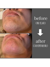 ブルーグロウ(Blue Glow)/お髭脱毛ビフォーアフター