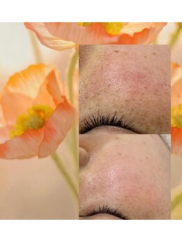 サロンド ユニバース(salon de universe)/シミやくすみ、肌のゴワつきに◎