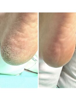 巻き爪補正店 湘南辻堂店/足裏の角質・タコ・魚の目ケア