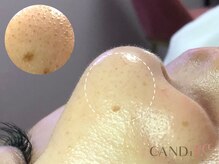 キャンディ 難波心斎橋店(CANDi)/ハイドラピーリング/黒ずみ毛穴