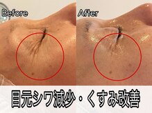 ヴィオール 名古屋栄店(VIOR)/美白効果大！ふっくらハリ肌へ！