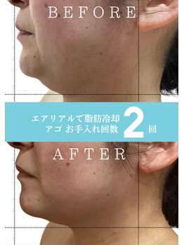エアリアル 中津店/パッと見で痩せ見えアゴ脂肪冷却