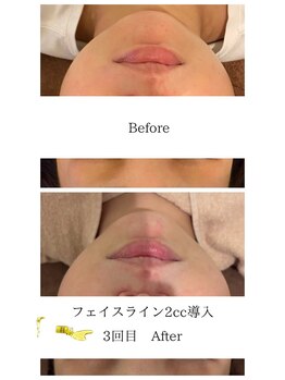 ラ セルフィー(Ra Selfee)/【レモンボトル】近日導入