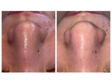 毛穴/黒ずみに人気の【毛穴再生ケア】で毛穴レスなうる艶肌へ