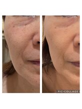 ペルナ(perna)/エイジングケア/シワ/くすみ