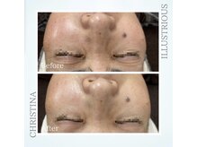 シャルムパリス(charme paris)/内側からふっくら◎１回の変化