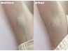 ワキ脱毛¥3300《高出力の高い効果に驚き！》　