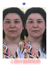 アイワ鍼灸整骨院/美容鍼ビフォーアフター