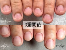 ツメハピ(tumehapi)/ 深爪ケアから３週間後