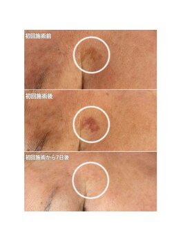 サロン ド マキ(Salon de Maki)/シミの変化が目に見える!