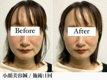 フラット(flat)/美容鍼で小顔リフトアップ