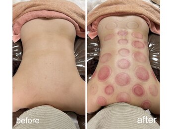 ミミ(MIMI)/【疲労改善】カッピング