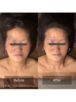 グレースフィオーレ 京橋店(gracefiore)/Before/After( 1回施術)