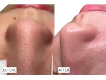 エングラッシー(en glassy)/BEFORE　AFTER　20代