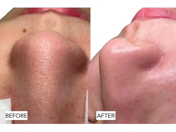 エングラッシー(en glassy)/BEFORE　AFTER　20代