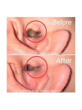 ハピネス 広島並木通り店(Happiness)/耳毛脱毛Before→After