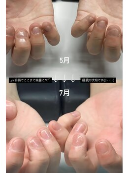 ネイルマン 横浜店(Nail Man)/自爪の育成/ビフォー＆アフター