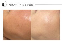 スパレーカ(Spa laka)/光カスタマイズ