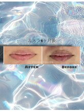 プリマプリート 各務原店/ルメラ施術効果!