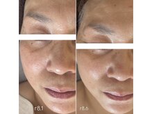 プリュムアイ フェイシャルホーム(prume eye.facial home)/before・after