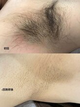 脱毛専門サロン エリクサー(Elixir)/Before After