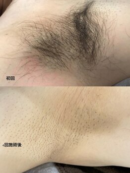 脱毛専門サロン エリクサー(Elixir)/Before After