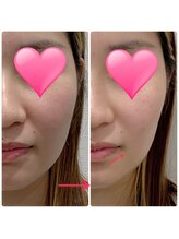 ルナート(Lunart)/EMSでフェイスラインスッキリ