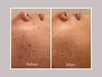 エスラボ オオサカ 心斎橋/剥離有×剥離無ハーブピーリング