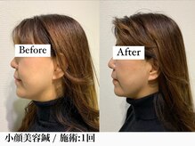 フラット(flat)/美容鍼で小顔リフトアップ