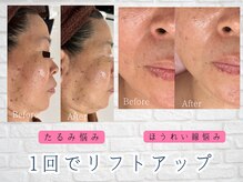 ブランリス 京都店(Blanclis)の雰囲気（エステ講師施術！驚きの効果！パスリルリフトUPコース/1回の効果）