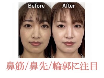 ラプリシュシュ 岡山店(Raplit)/隆鼻+輪郭矯正40分10回
