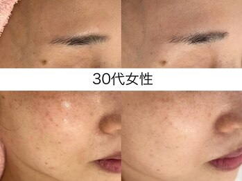 シミケア専門店 SAKURA 平塚店/平塚シミケア/伊勢店シミケア