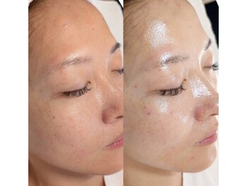 レティティア(Laetitia)/セラピールBefore After