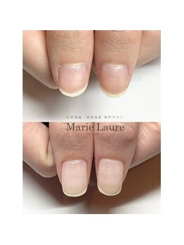 深爪矯正/自爪育成/ネイルケア