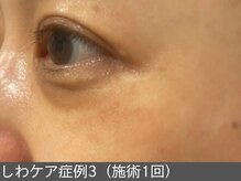 オアシスラグーン(OASIS LAGOON)/しわ改善（症例3施術1回）50代