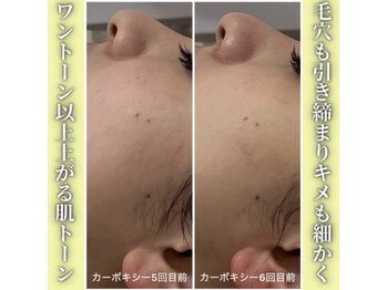 ハニエル(Haniel)/カーボキシー症例