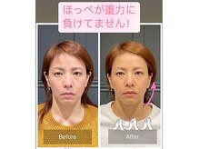 サリエ(S'allier)の雰囲気(美容鍼と通電 2週間に1度、6回施術のお客様のビフォーアフター)