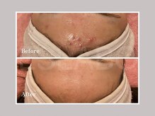 エスラボ オオサカ 心斎橋/剥離ありハーブピーリング