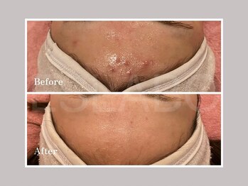 エスラボ オオサカ 心斎橋/剥離ありハーブピーリング