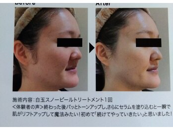 シエル/スノーホワイトピールビフォー