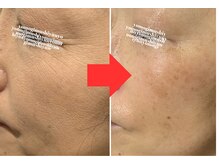 カラーリリー アンド ユン(Calla lily & yun)/潤いアップ！ヒト幹細胞コース