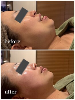 セルベッラ(cerbella)/小顔艶肌ボンバーフェイシャル